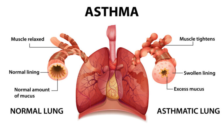 CIDO ASTHMA FOUNDATION : Asthma Education Empowers